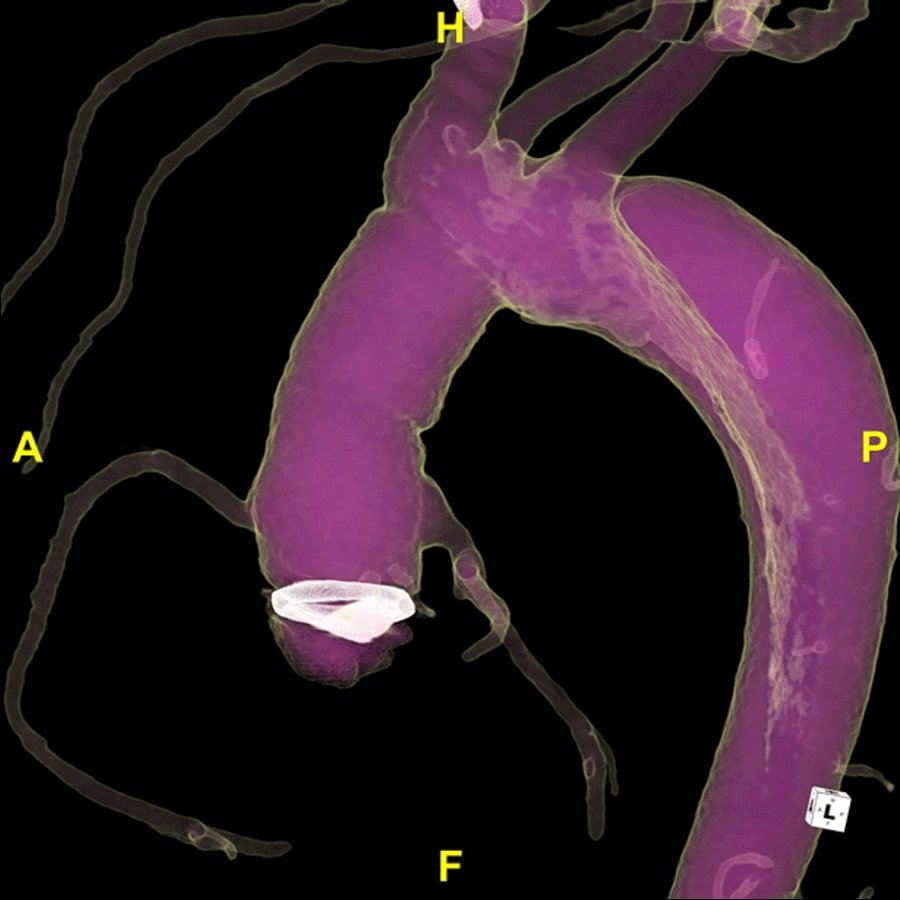3D aorta render