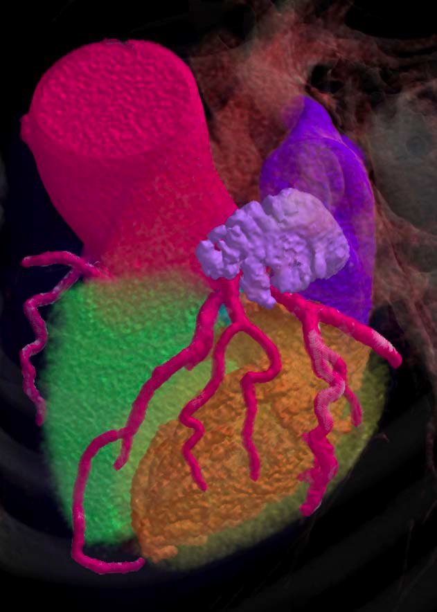 3D cardiac render with coronary arteries