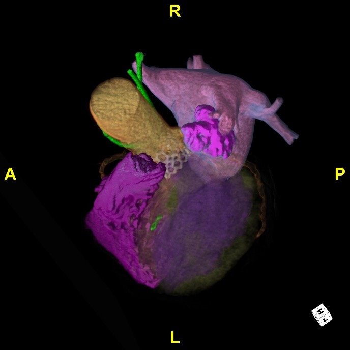 3D structural heart render