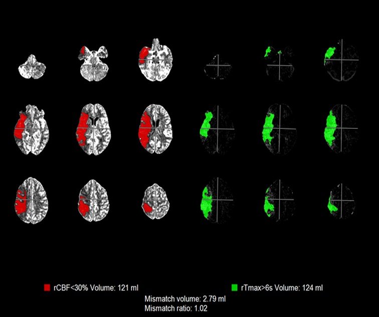 Neuro perfusion mismatch maps