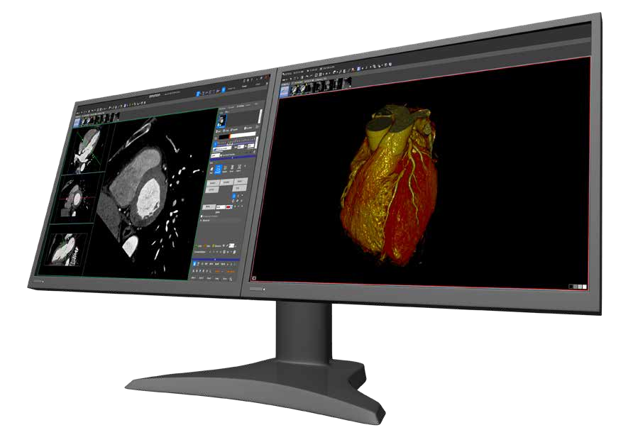 Dual-monitor advanced visualization workstation showing cardiac CT and a 3D heart render